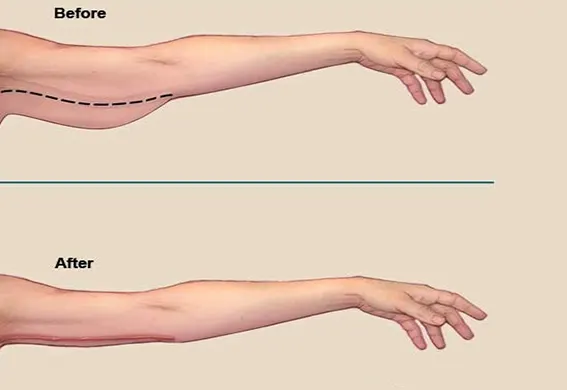 جراحی لیفت بازو