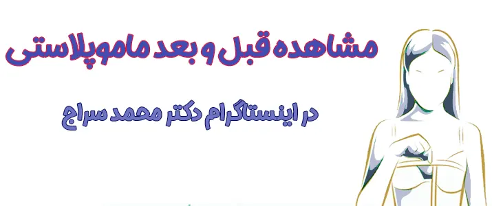 عکس قبل و بعد ماموپلاستی