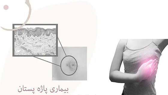بیماری پاژه پستان