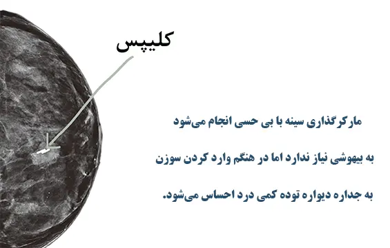 مارکرگذاری سینه