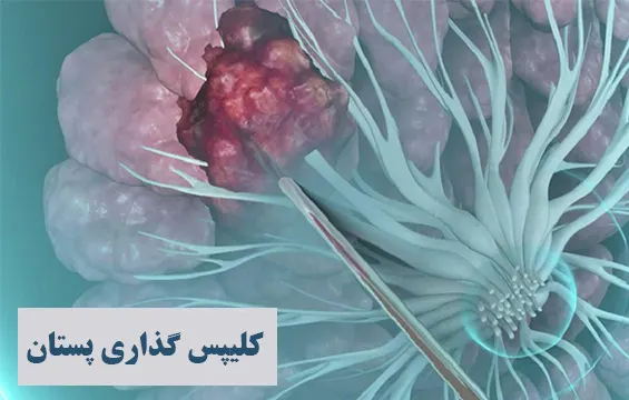 کلیپس گذاری پستان