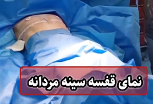 درست کردن سینه در خانم ترنس