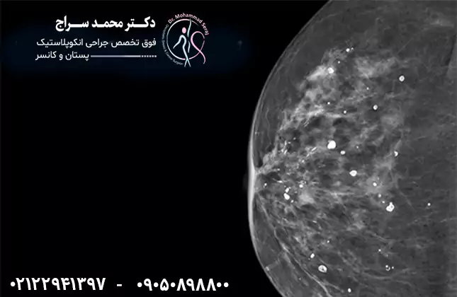 رسوب کلسیم سینه