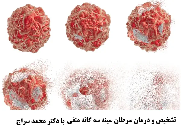 درمان سرطان سینه سه گانه منفی
