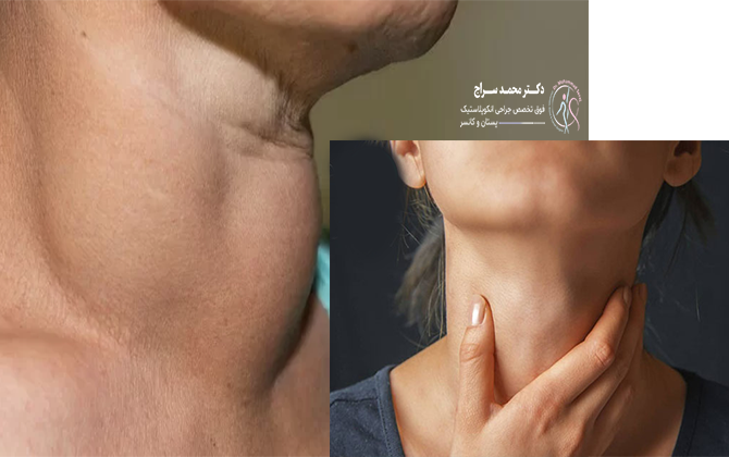 جراحی گره تیروئید