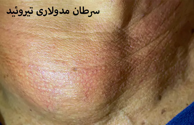 کارسینوم مدولاری