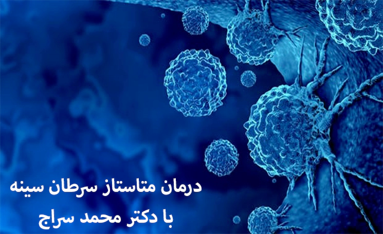 درمان متاستاز سرطان سینه